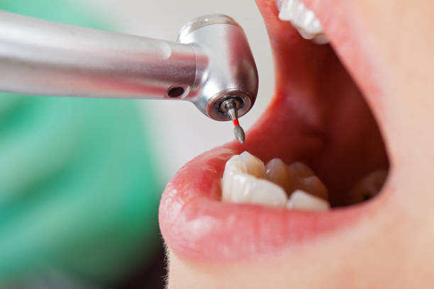 Best Knocked-Out Tooth (Avulsed Tooth) Treatment in Edwards Af, CA